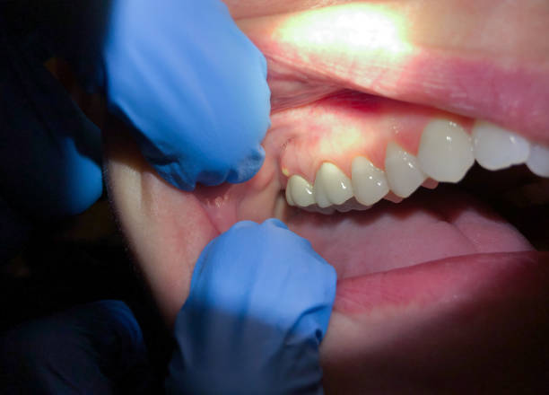 Best Dentist for Tooth Abscess  in Loretto, PA